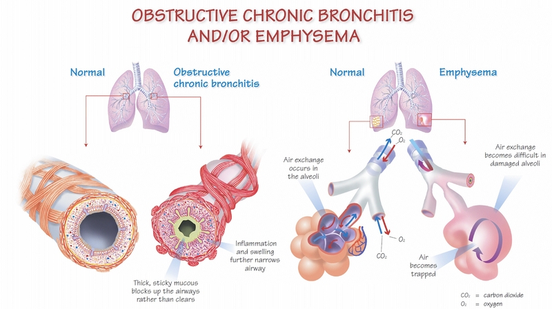 What Is COPD